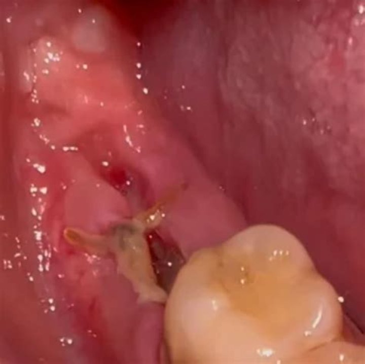 Can I go back to work the next day after a tooth extraction?