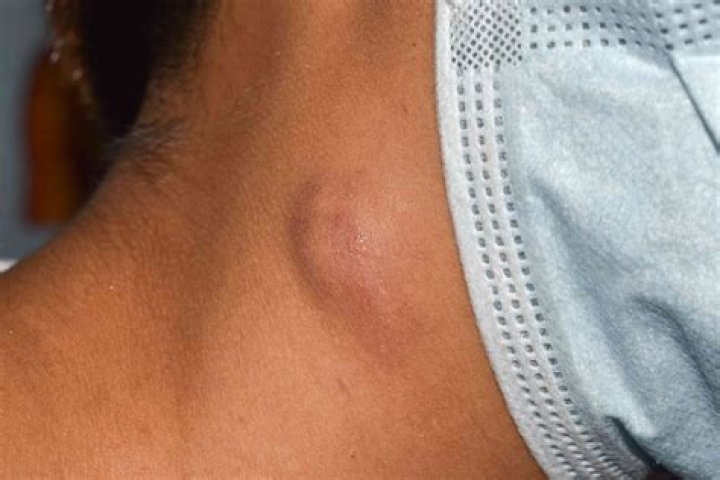 Can lymphoma lumps be pea sized?
