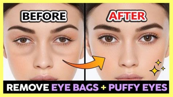 How can I permanently remove eye bags at home?