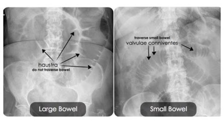 How can you tell the difference between small bowel and large bowel obstruction?