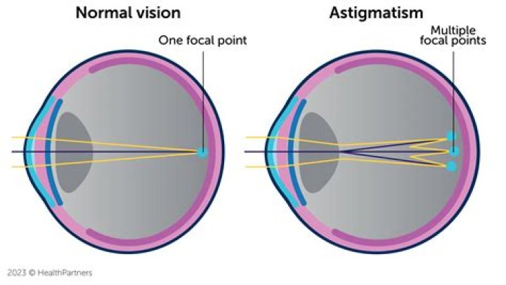 How do you cure astigmatism?