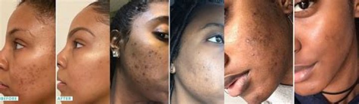 How fast does kojic acid work on hyperpigmentation?