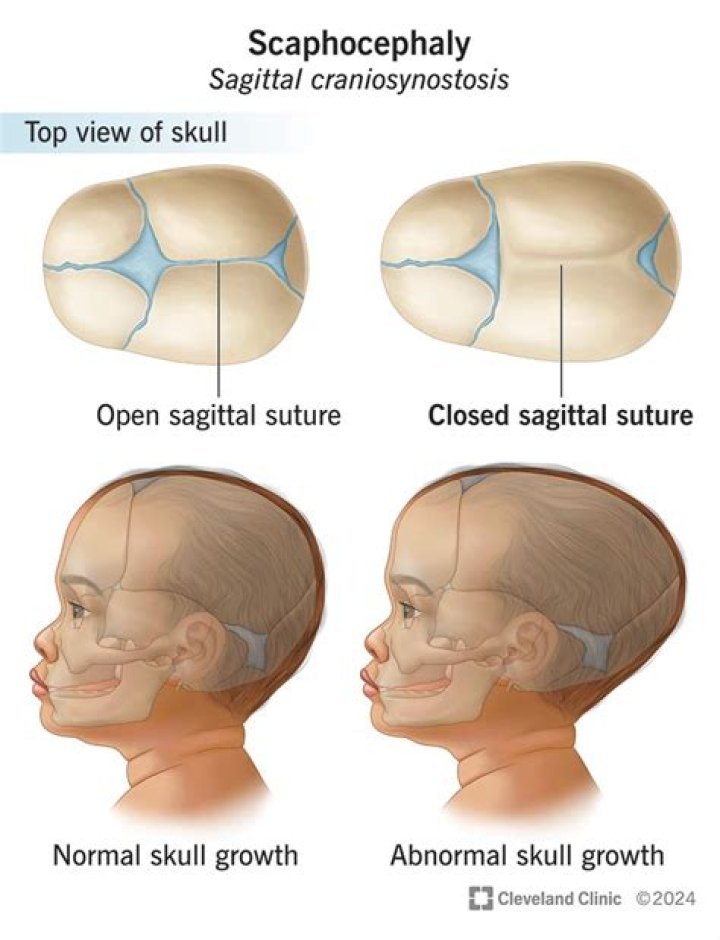 How long does craniosynostosis surgery take?