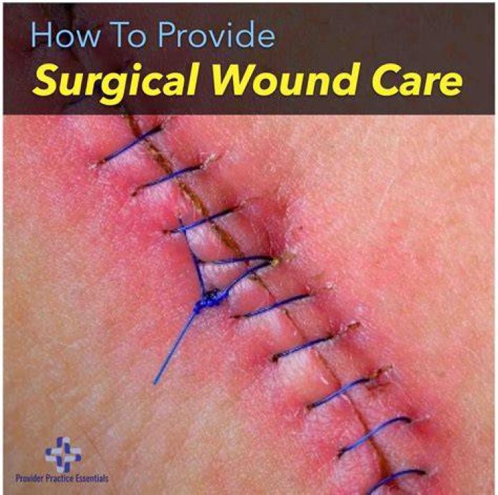 How long should a surgical wound take to heal?