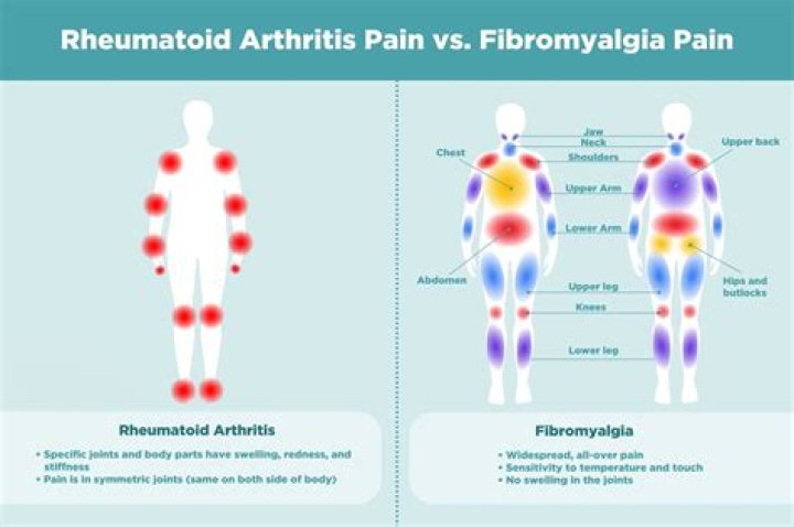 Is fibromyalgia a type of arthritis?