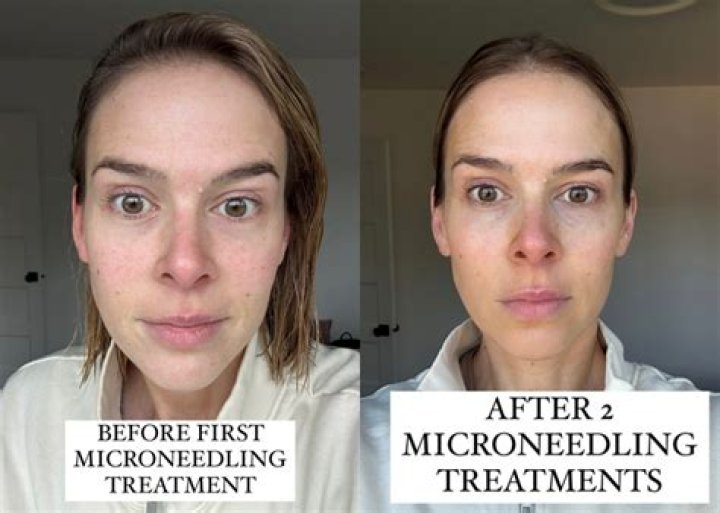 Is microneedling worth doing?
