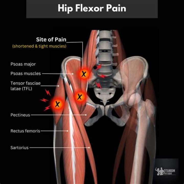 Should I run if my hip flexor hurts?