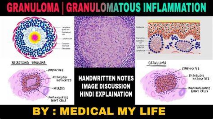 What does granuloma feel like?