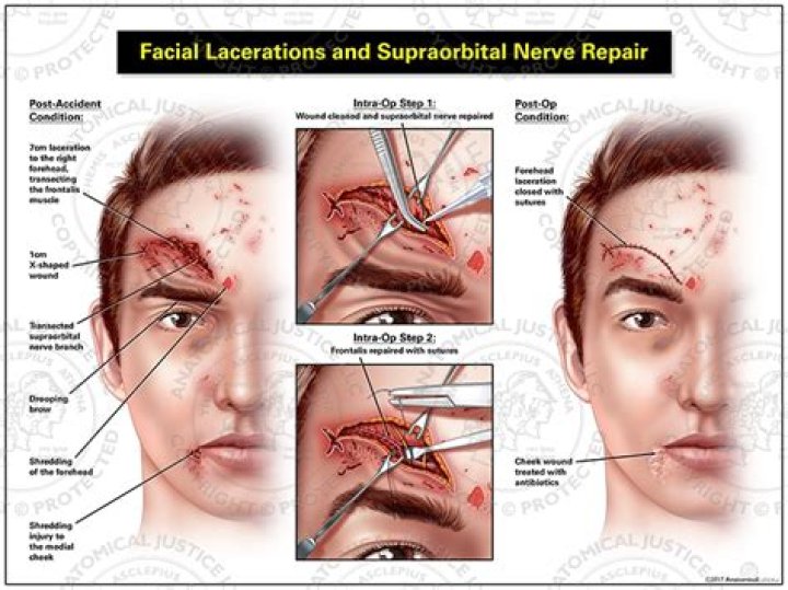 What does nerve damage in the face feel like?