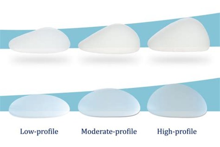 What holds breast implants in place?