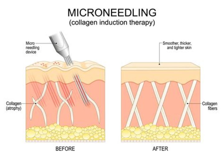 What is microneedling best for?