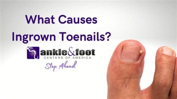 Where should I go for ingrown toenail?