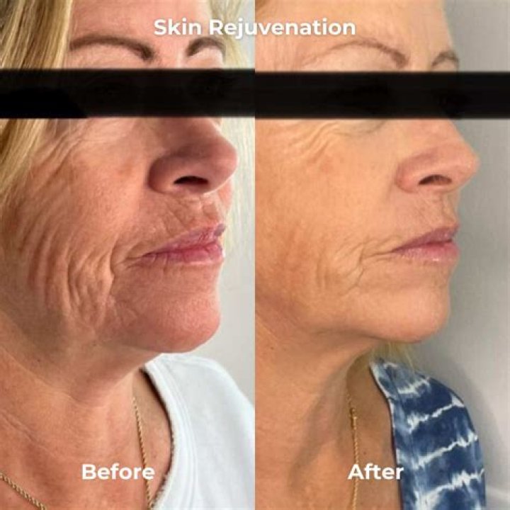 Which is better plasma pen or microneedling?