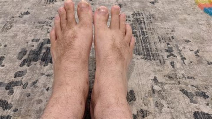 Why am I getting brown spots on my feet?