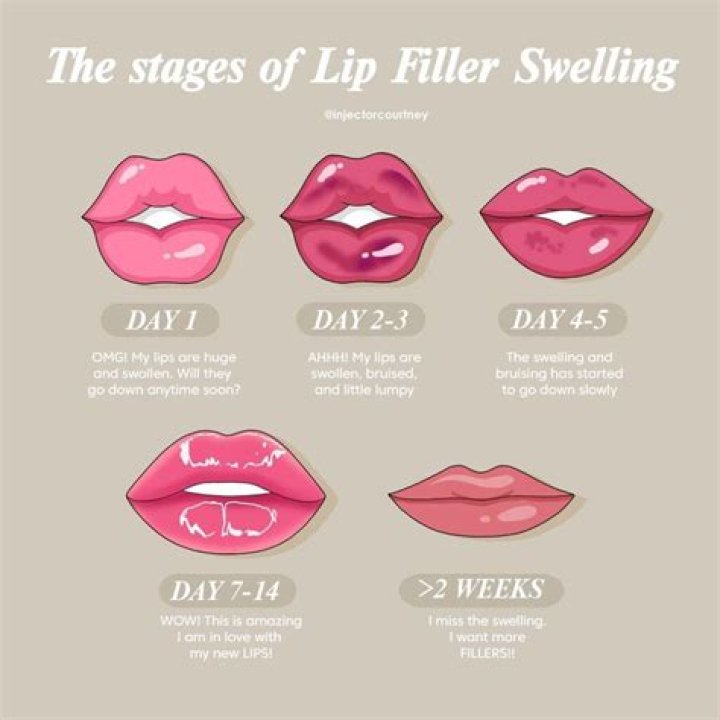 Why are my lips swollen after kissing?