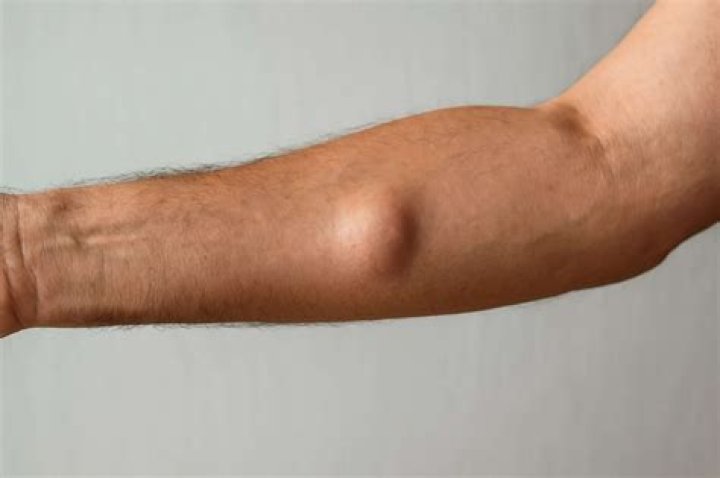 Why do I have little balls under my skin?