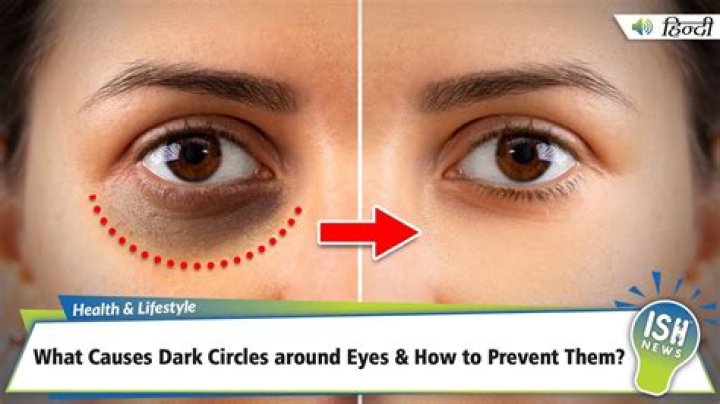 Why do I have purple rings around my eyes?