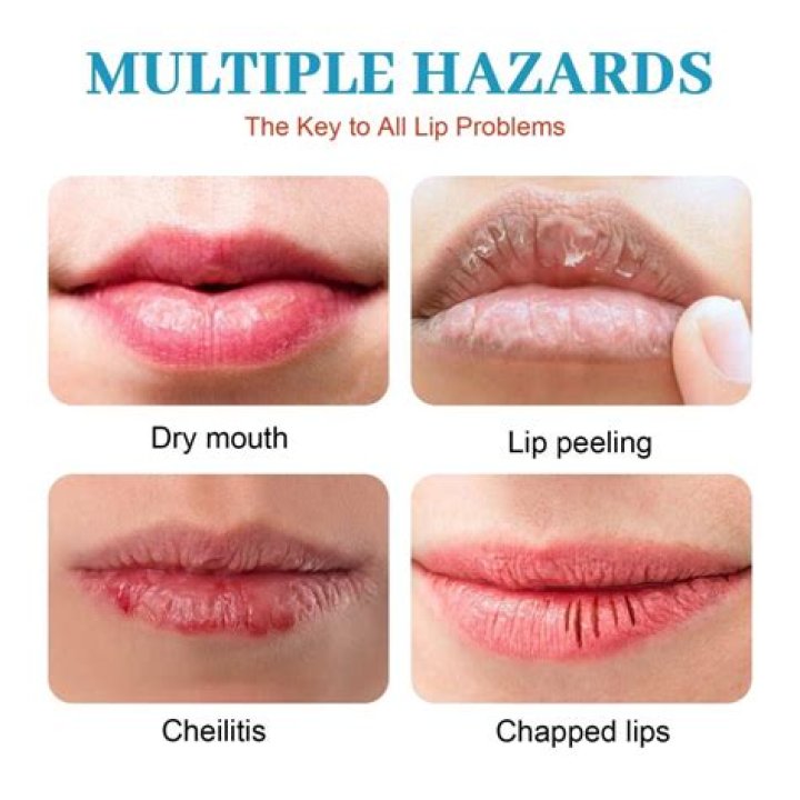 Why do your top lips disappear when you get old?