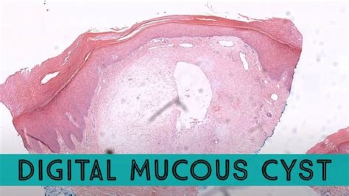 Why shouldn't you pop a digital mucous cyst?
